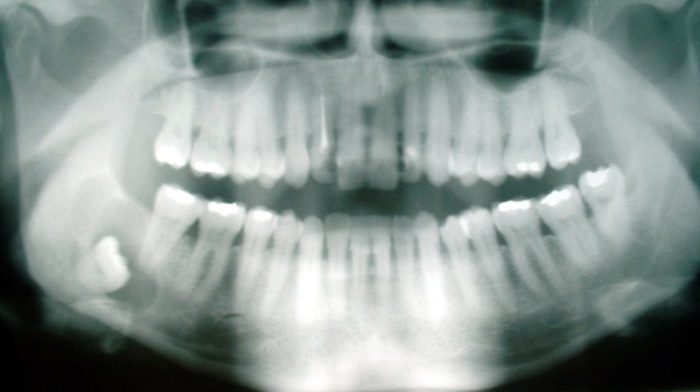 Full-mouth X-ray with impacted wisdom tooth