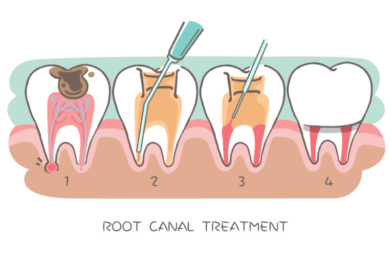 Root Canal Myth #2: Root Canals Cause Illness