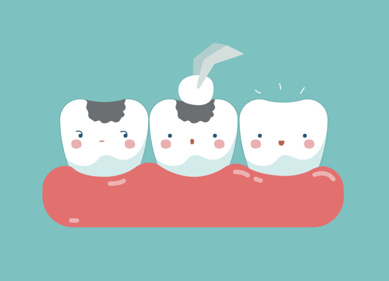 What to Know About Tooth Fillings