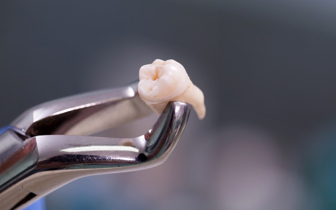 Should You Pull Your Own Tooth at Home?
