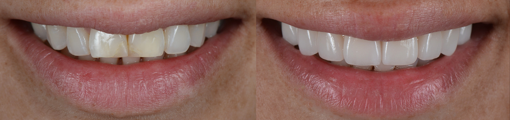 Veneer Before And After